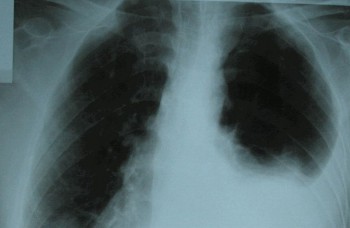Prevratný objav: Ako sa dá zlikvidovať rakovina pľúc?