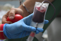Pacienti s hemofíliou môžu vďaka pokroku v medicíne žiť plnohodnotne