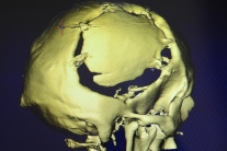 V lebke tohto muža je unikátny slovenský implantát